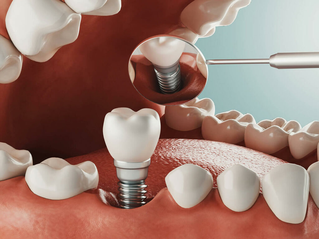 graphic of dental implant