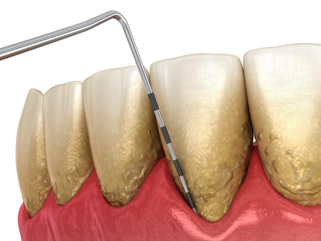 periodontal disease treatment graphic