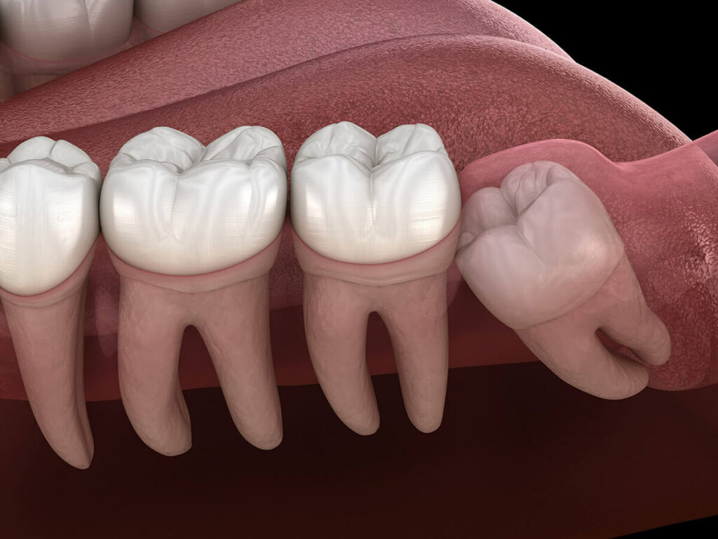graphic of a tooth being extracted from the lower row of teeth