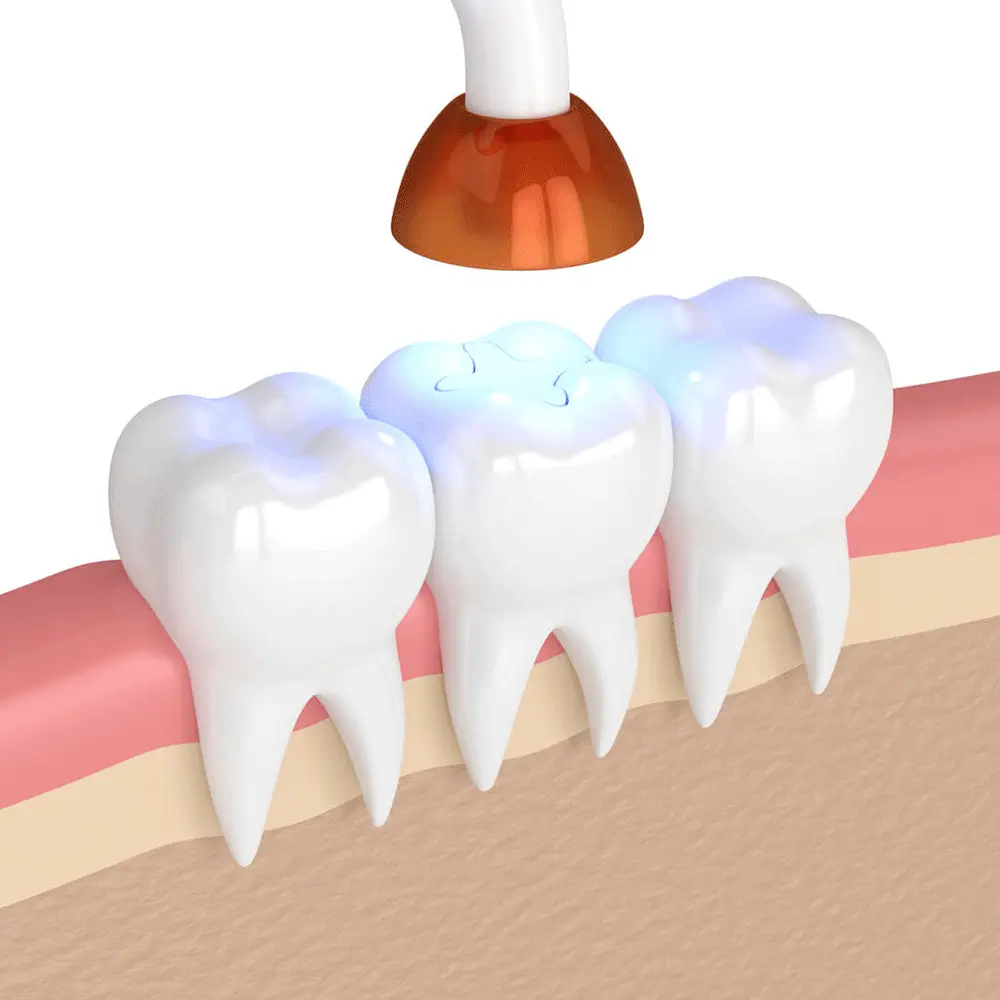 illustration of a blue light being applied to a tooth filling to secure the filling